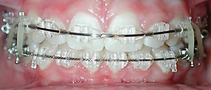 Inspire ICE Clear Braces